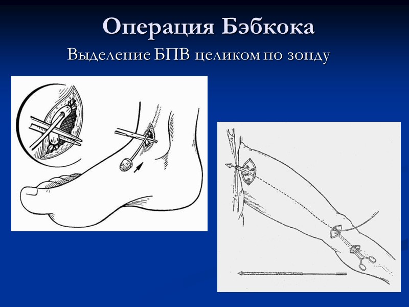 Операция Бэбкока Выделение БПВ целиком по зонду